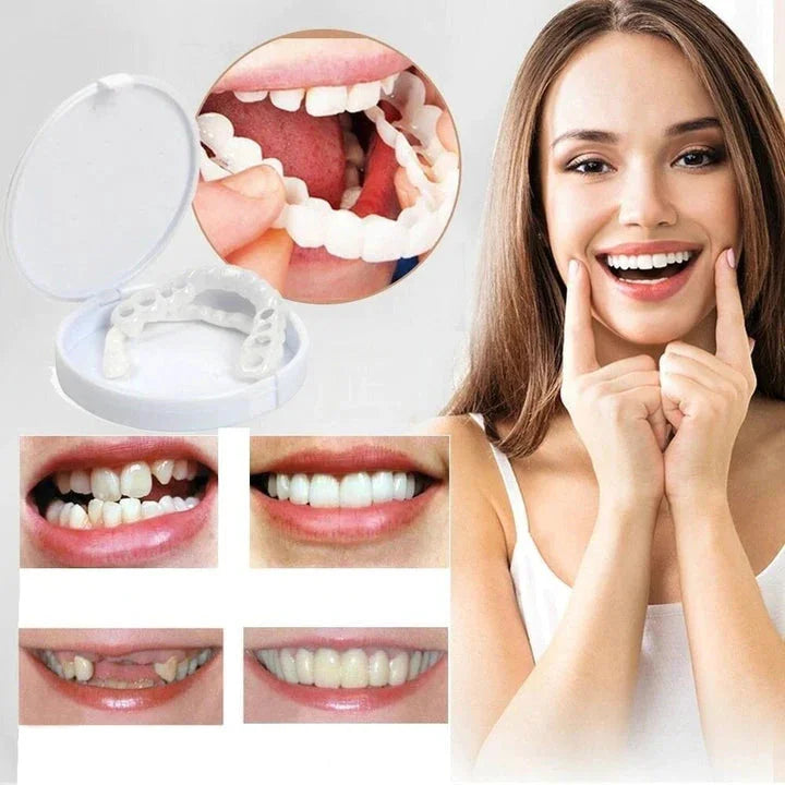 Snap-On Smile veneers voor een natuurlijke, cosmetische glimlach. Gemakkelijk aan te brengen gebitscorrectie.