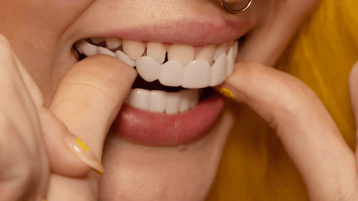 Cosmetische Snap-On Smile facings verbergen verkleuringen en zorgen voor een perfecte glimlach.
